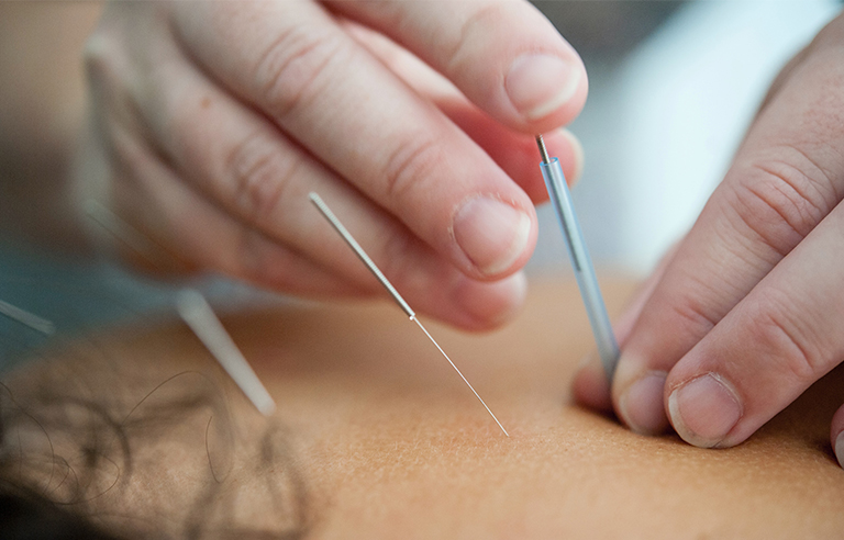 acupuncture in St. Petersburg FL